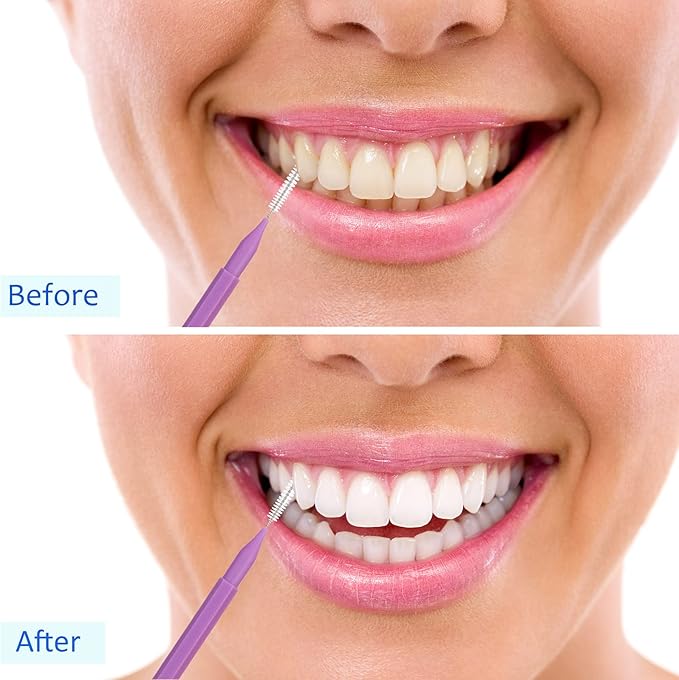 100 Pieces Braces Brush for Cleaner Interdental Brush Toothpick Dental Tooth Flossing Head Oral Dental Hygiene Flosser Toothpick Cleaners Tooth Cleaning Tool (Purple)